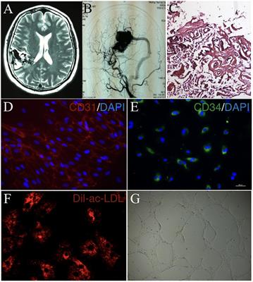 Activin Receptor-Like Kinase 1 Combined With VEGF-A Affects Migration and Proliferation of Endothelial Cells From Sporadic Human Cerebral AVMs